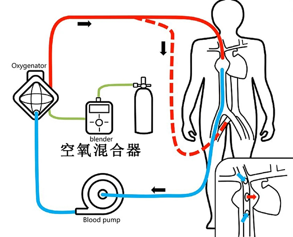 康心空氧混合器：无源压差报警，保障ECMO治疗安全