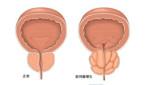 前列腺增生有什么办法解决呢？AI-HIFU技术是个好选择！